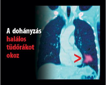 Hungary 2012 Health Effects lung - internal image, lung cancer